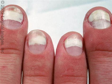 leukonychia spots result from _____.|Leukonychia: Symptoms, Causes, Treatment .